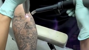 VIDEO ASA se scoate un tatuaj nedorit! Cum arata pielea dupa ce a fost indepartat cu laserul