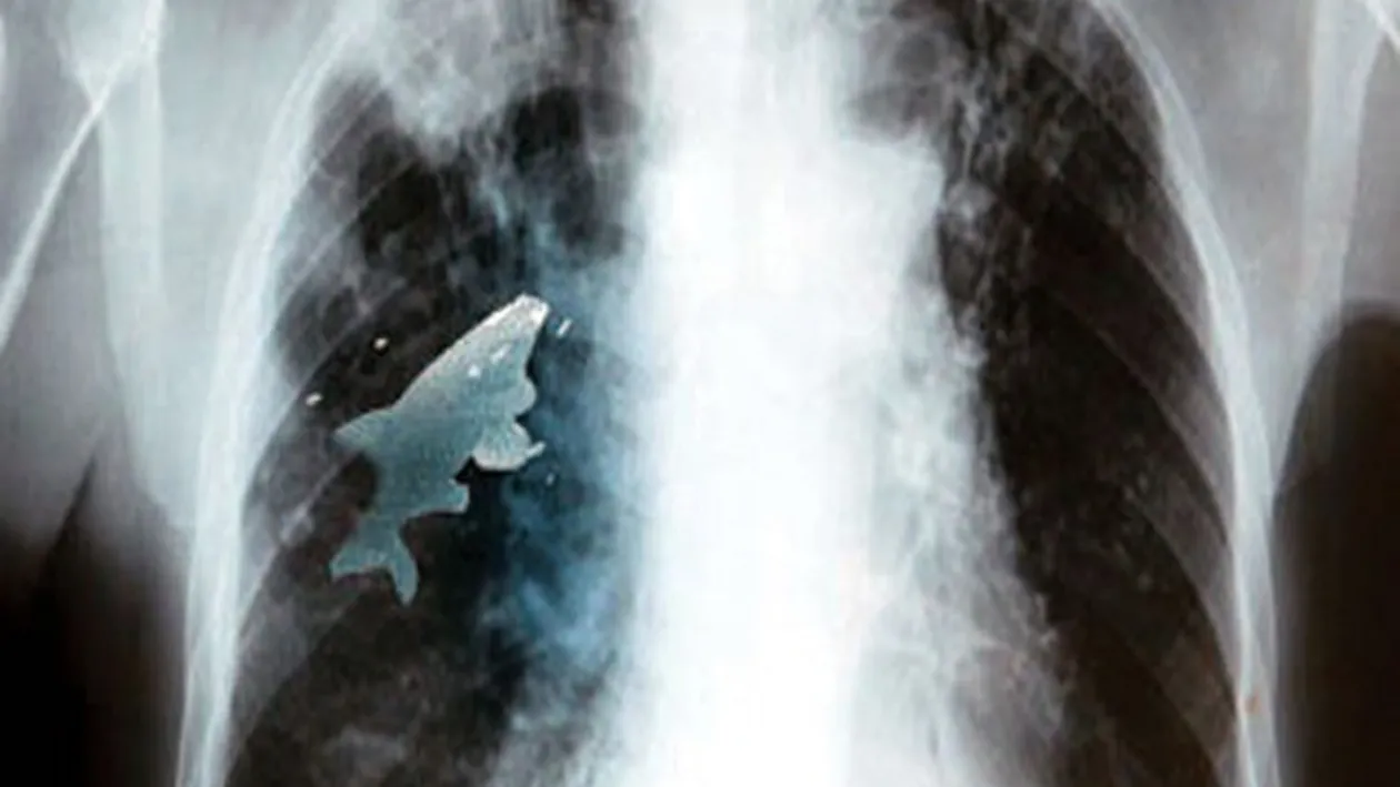 Incredibil! Doctorii au scos un peste viu din plamanul unui baiat! VEZI cum a ajuns acolo