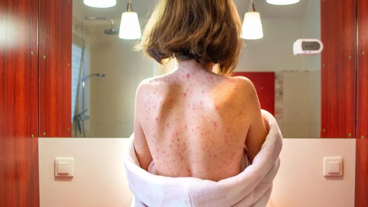 Rujeola face prăpăd. Aproape 160 de copii au murit. Peste 2.000 de cazuri de infectare