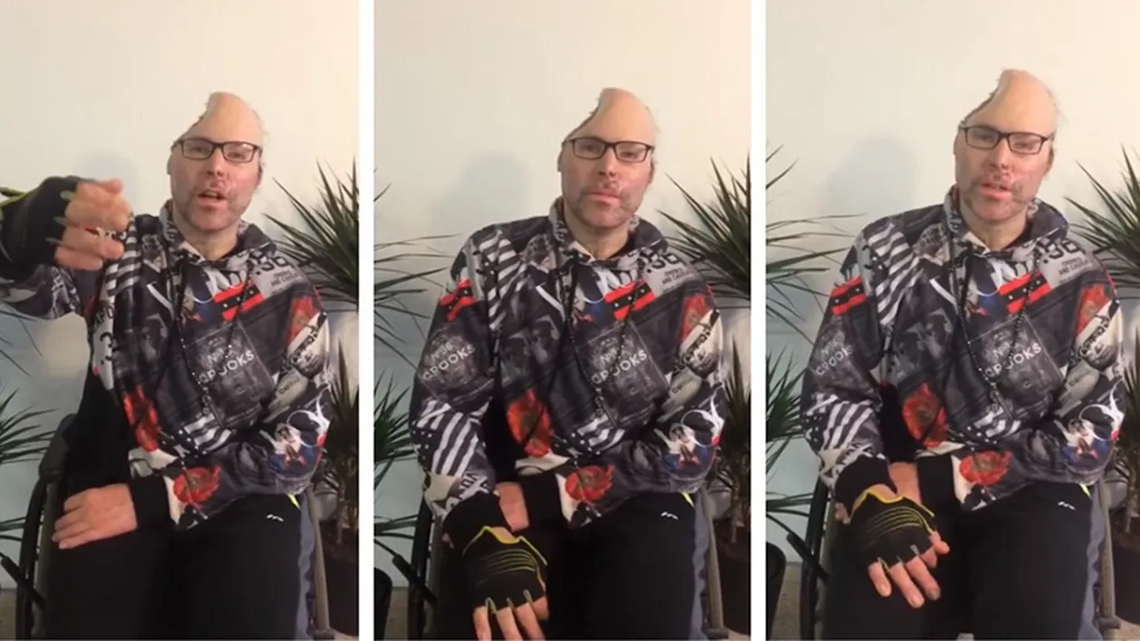 Rapper-ul Dr Knarf, paralizat și mutilat și pe viață. Primele imagini după ce medicii i-au îndepărtat jumătate din cap în urma exploziei produsă la un laborator de droguri