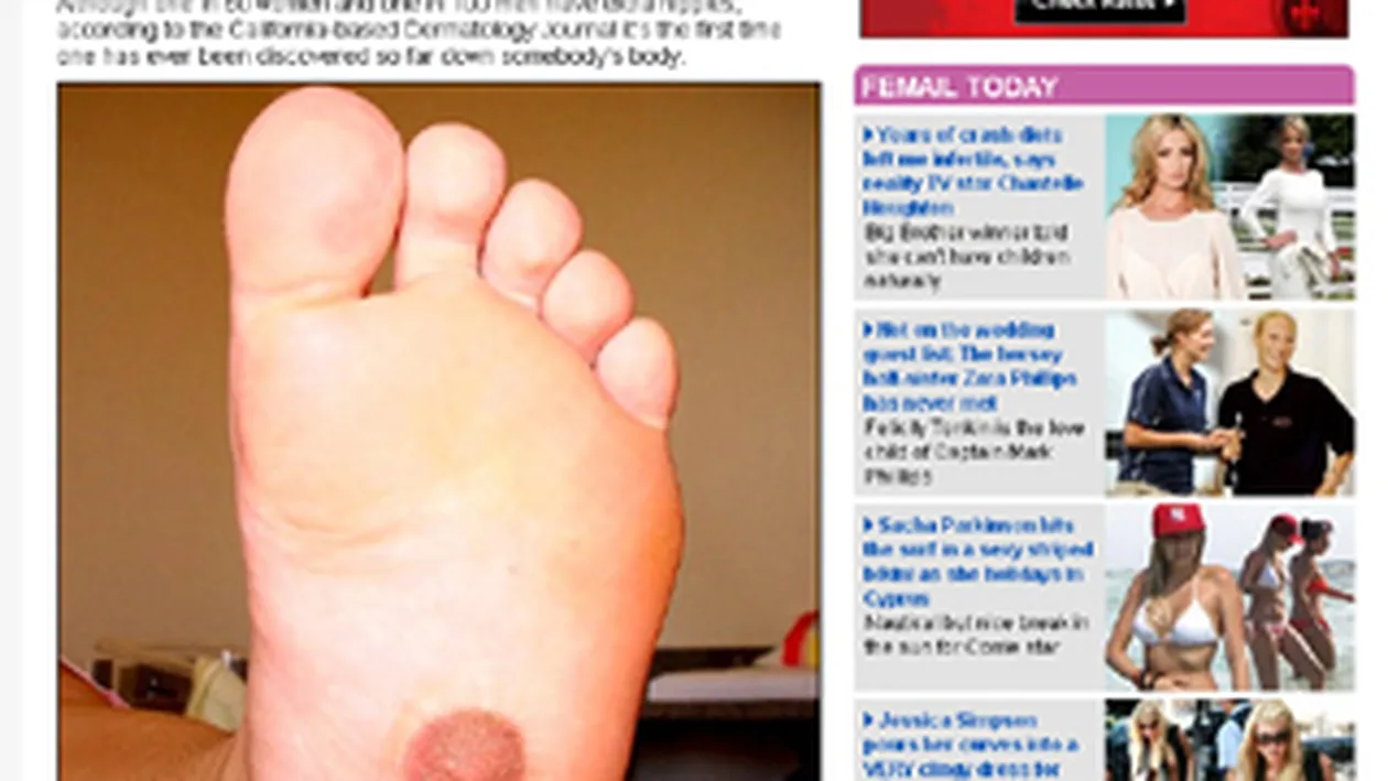 Unei femei de 22 de ani i-a crescut un sfarc in talpa