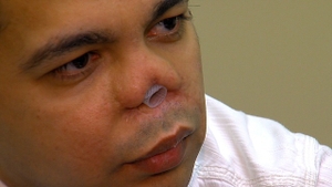 A vrut să arate bine, dar medicul l-a distrus! Cum arată acest bărbat după opt operatii: "Mai bine mor decât să trăiesc asa"