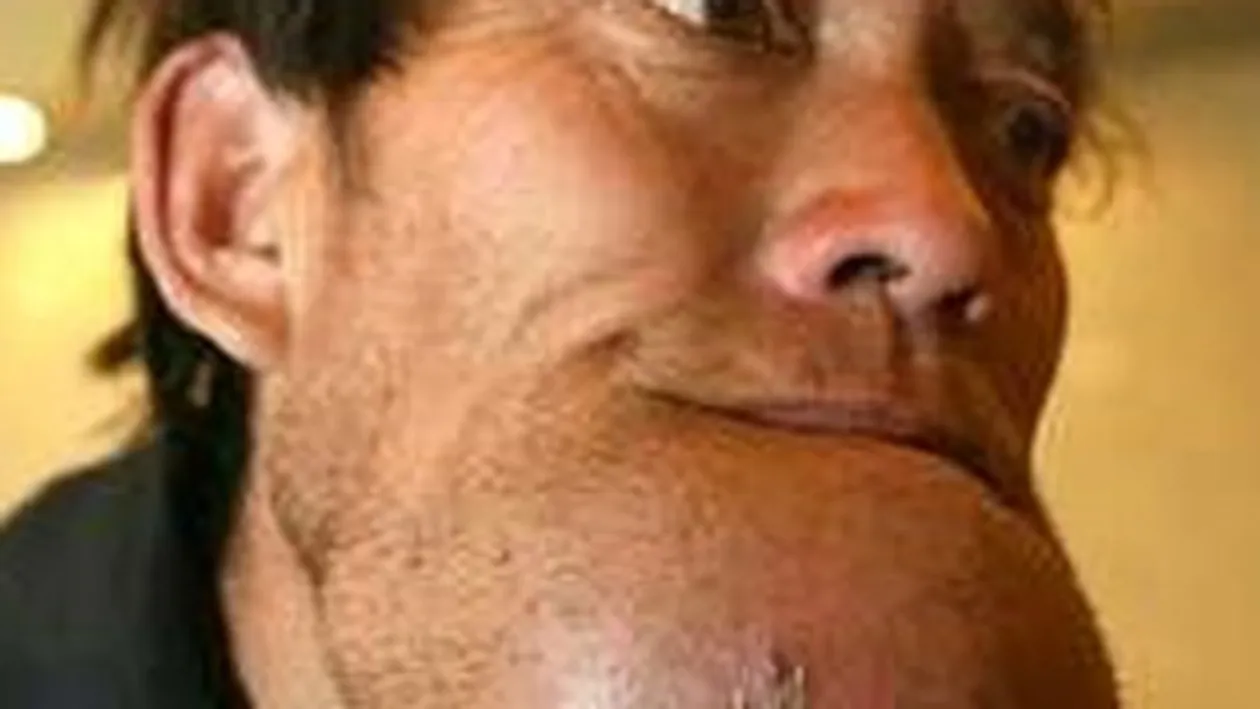 INGROZITOR! Unui chinez ii poate exploda barbia oricand! I s-a umflat incredibil de mult!