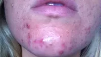 S-a spălat pe faţă cu bicarbonat de sodiu, ca să scape de acne! Rezultatul a şocat-o