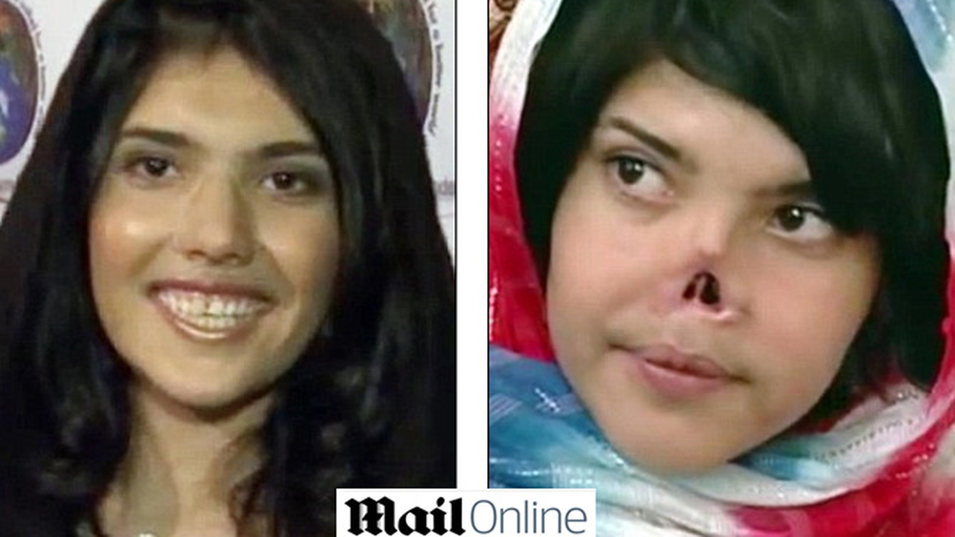 Fata care a sfidat Islamul si a fost mutilata de sotul ei are sansa unei vieti normale! Medicii i-ar refacut chipul