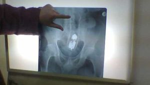 Șocant. Un tânăr din Olt a ajuns la Urgență după un ”accident casnic” ciudat: ”Mama lui a spus că...”