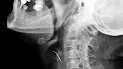 O femeie din Peru a stat 43 de zile cu un cui în gât fără să-și dea seama