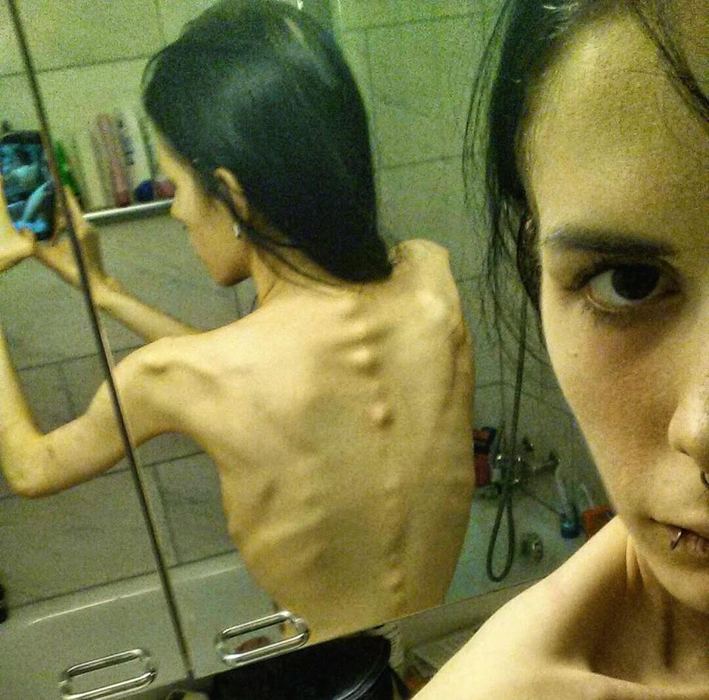 Cazul şocant al fetei care îşi ascundea mâncarea în urechi! Julia cântărea 32 de kilograme, dar a învins anorexia. Cum a reuşit!