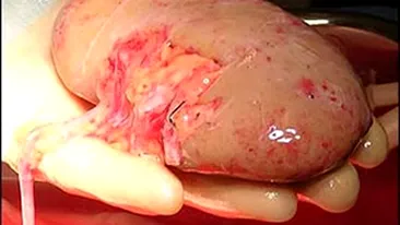 Au transportat organele pentru transplant cu un avion plin cu pasageri