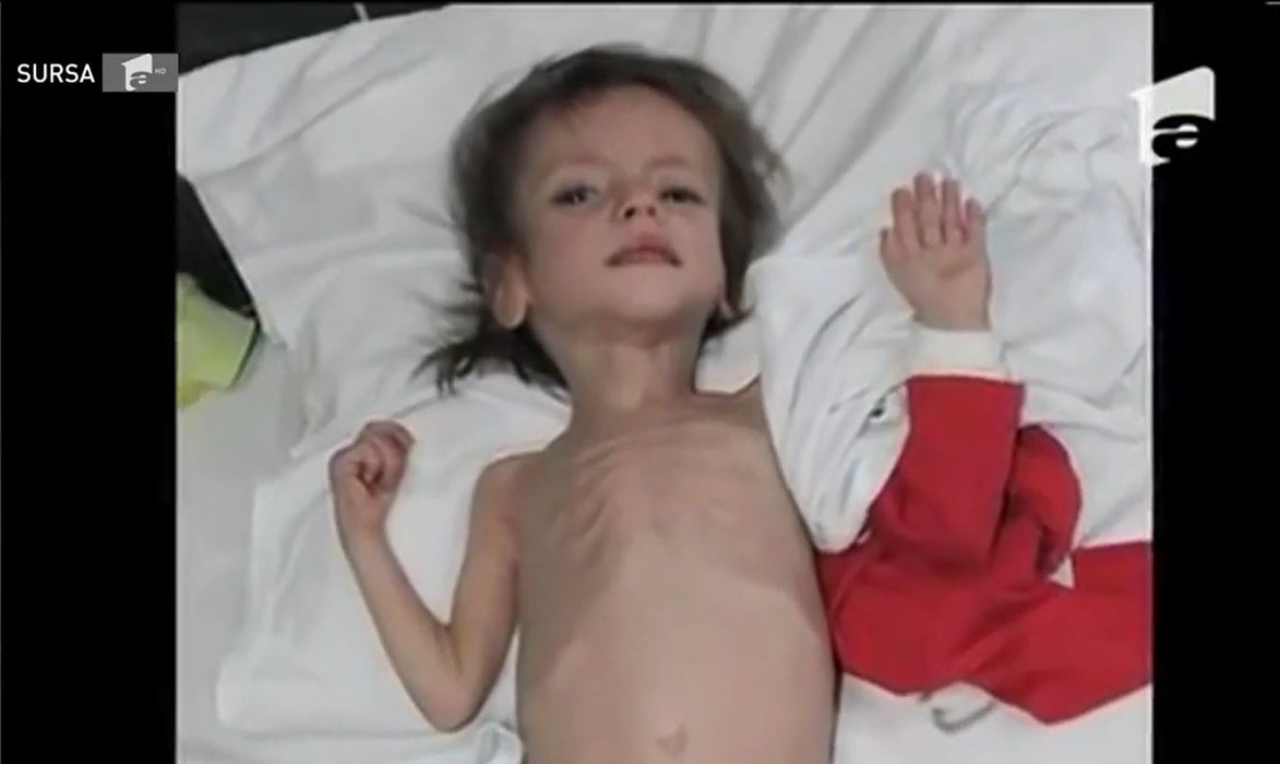 Ce frumoasă este Flori, fetița care a fost hrănită doar cu pufuleți și ceai! Recent, părinții adoptivi i-au arătatpozele când era într-o stare critică: “A început să plângă…”