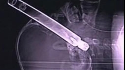 VIDEO A ajuns la spital cu o teava de 30 cm infipta in cap
