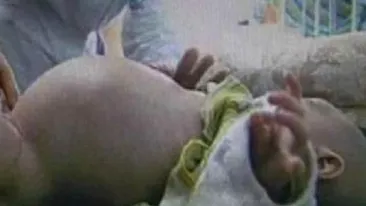 A uimit lumea medicală! Un băieţel de numai doi ani şi-a născut propriul FRATE! VIDEO IREAL