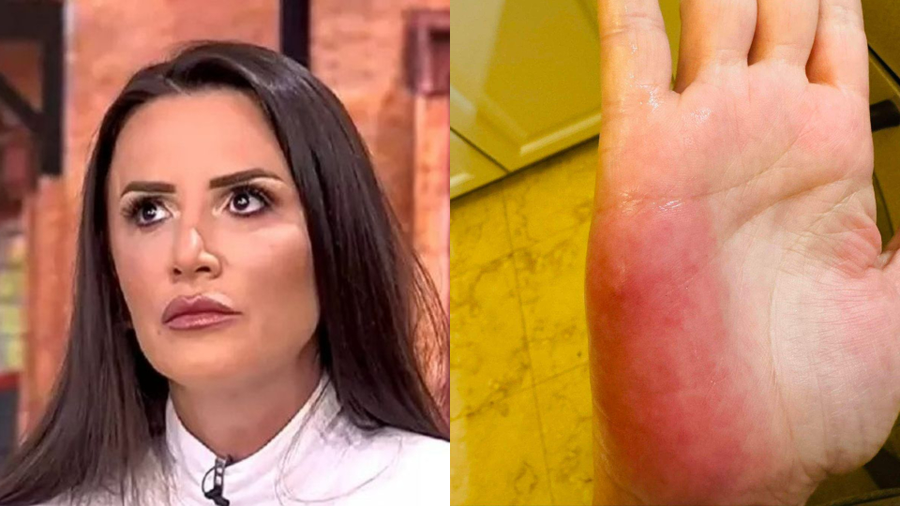Ce a pățit Mara Bănică la mână. Imaginea cu palma roșie i-a îngrijorat pe fani