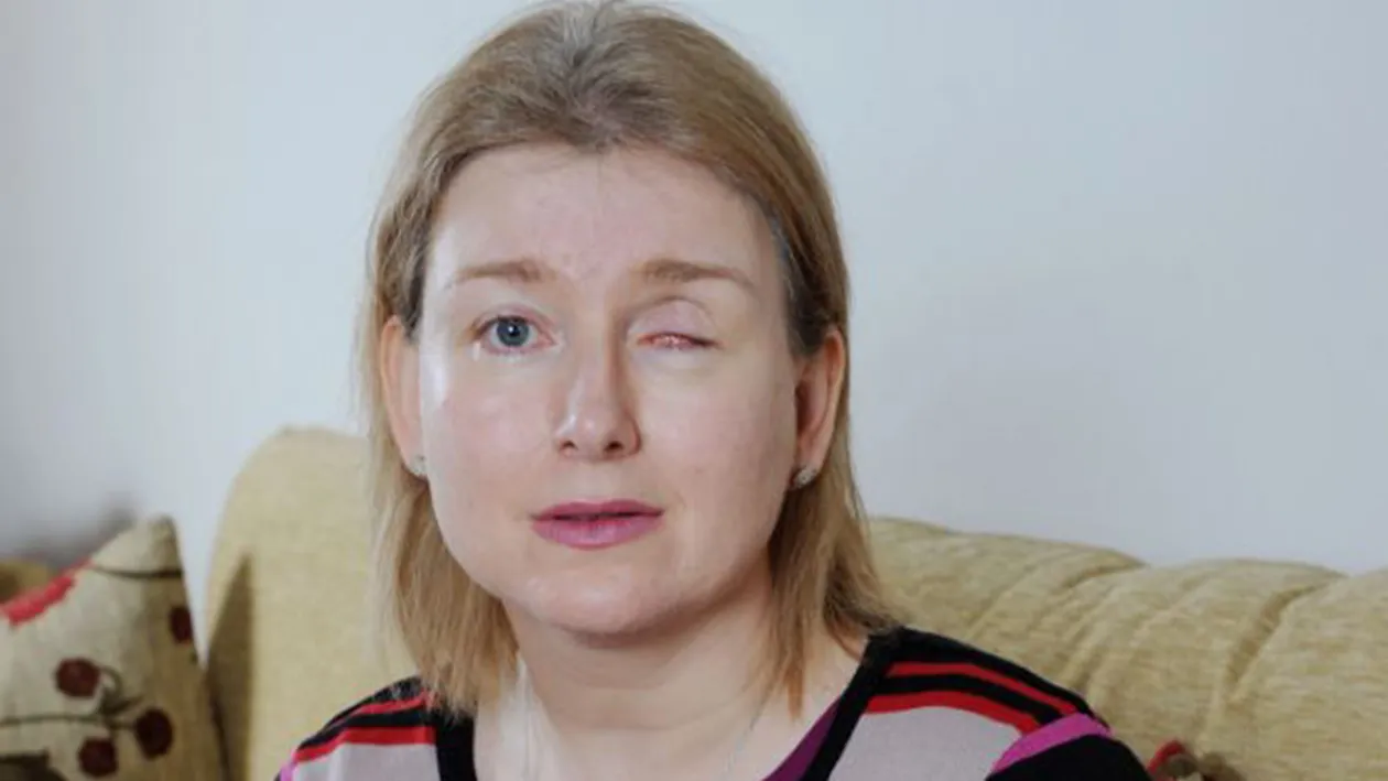 FOTOGRAFII ŞOCANTE! O mamă a doi copii şi-a pierdut un ochi din cauza lentilelor de contact!