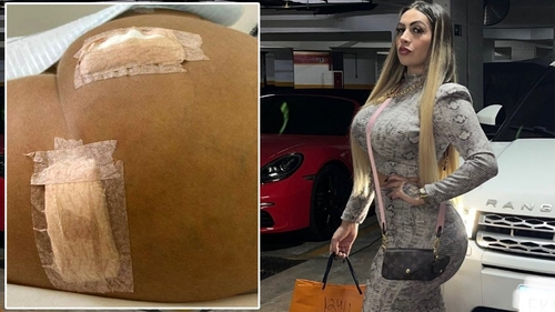 Ce a pățit tânăra din imagine, după ce și-a făcut o operație de remodelare a posteriorului, pe care a dat 9.230 de euro. Când s-a uitat în oglindă, să cadă din picioare