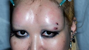 Tatuajele si piercingurile sunt depasite! Noua moda in materie de mutilare fizica este oripilanta: limbi despicate, dinti de vampiri si frunte monstruoasa!