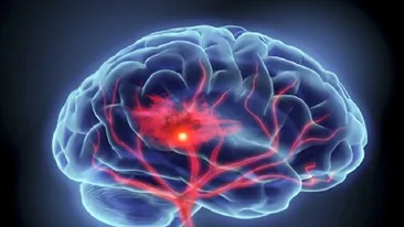 COVID-19. De ce fac atac cerebral pacienții sub 50 de ani. Explicația unui neurochirurg