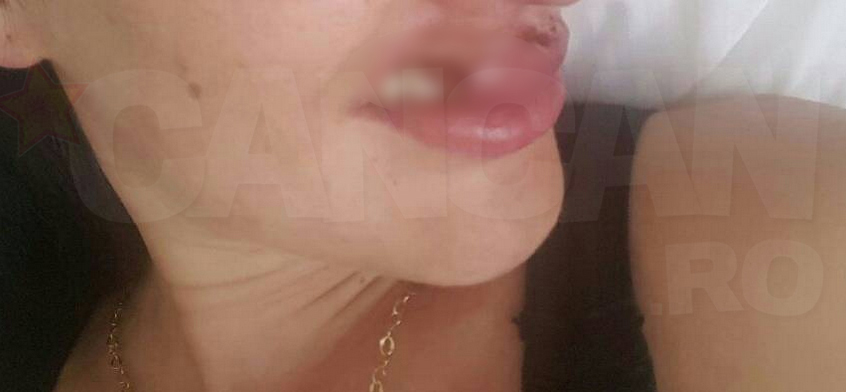 O pacientă fotomodel povesteşte cum a mutilat-o doctorul Kasem. Atenţie! Imagini cu un puternic impact emoţional! ”Măcelarul din Floreasca” i-a topit buzele cu acid!