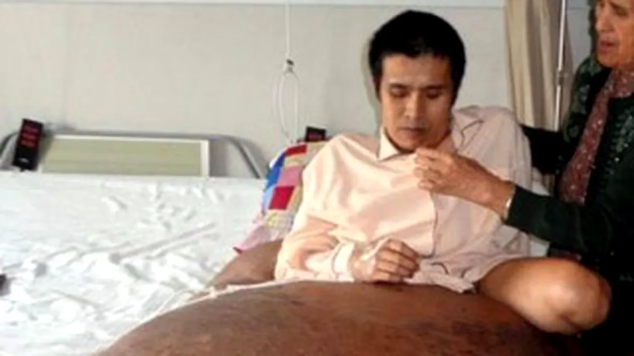Un vietnamez este operat pentru a scapa de o tumora ce cantareste 90 de kilograme