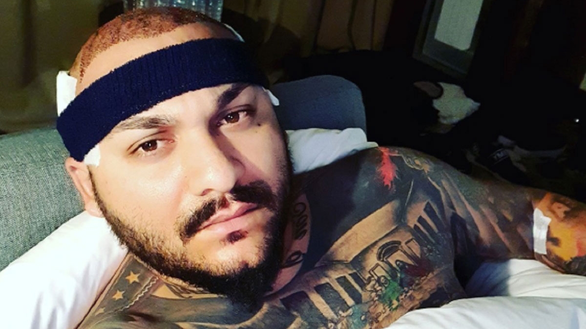 Cum arată Dani Mocanu cu păr, după ce și-a făcut implant! E de nerecunoscut