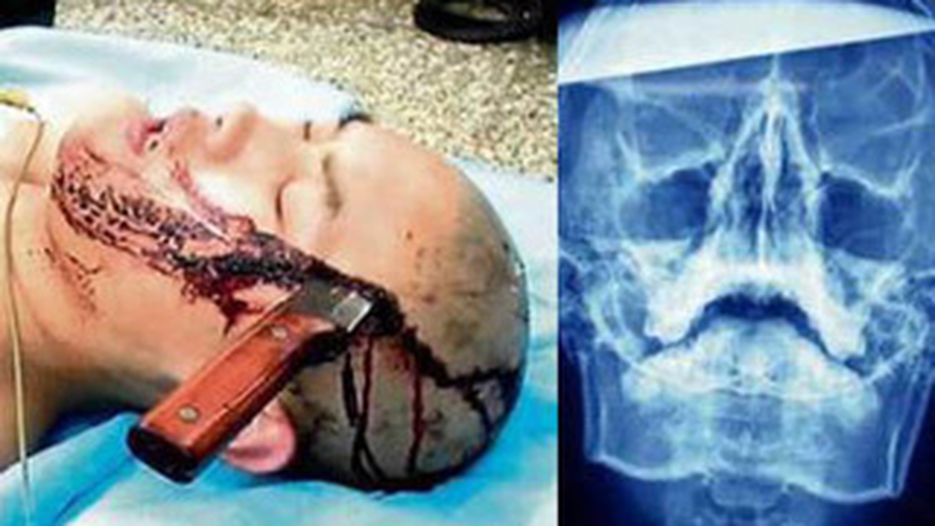 SOCANT! Un baiat de 16 ani din China a ajuns cu un cutit in cap la spital