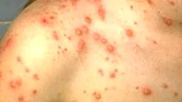 O fata de 11 ani bolnava de varicela a murit, dupa ce bunica ei a dat-o cu o solutie toxica crezand ca are raie