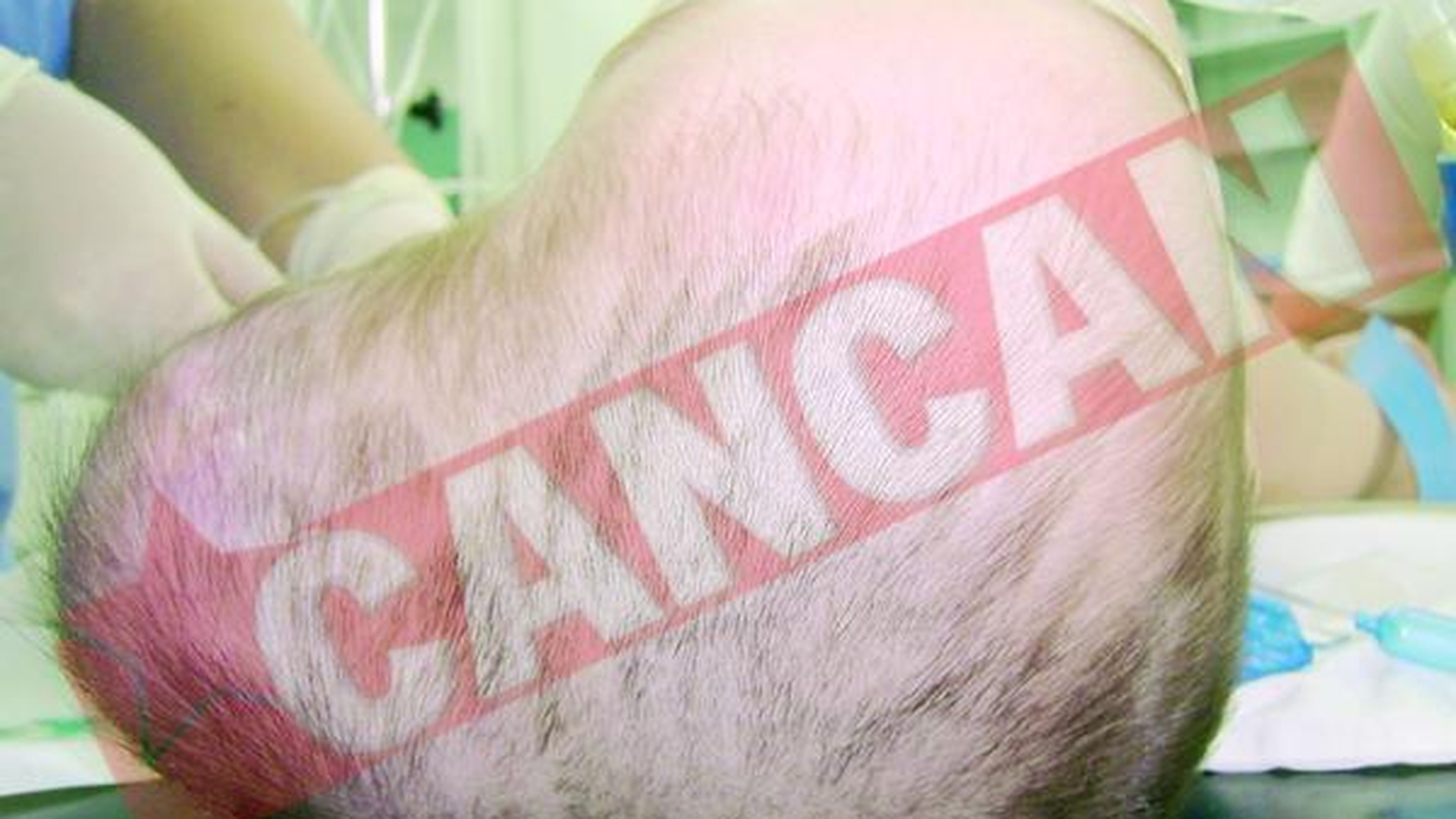 Un baietel de un an traia cu o tumora uriasa la cap