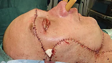 Premieră in lumea medicală! Cum arată omul căruia i s-a făcut primul transplant de faţă din lume