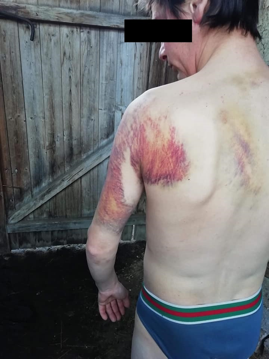 Urmele bătăii pe care tânărul ar fi primit-o la poliție