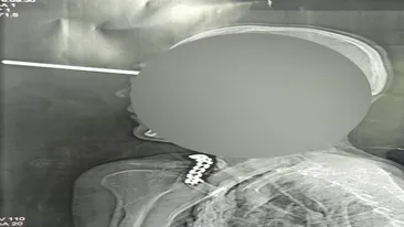 Medicii, socati cand au vazut radiografia acestui barbat. Imposibil. Imaginile sunt de cosmar. E o minune ca inca respira