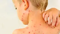 Alertă medicală în România! Boala contagioasă care face ravagii în școli și grădinițe