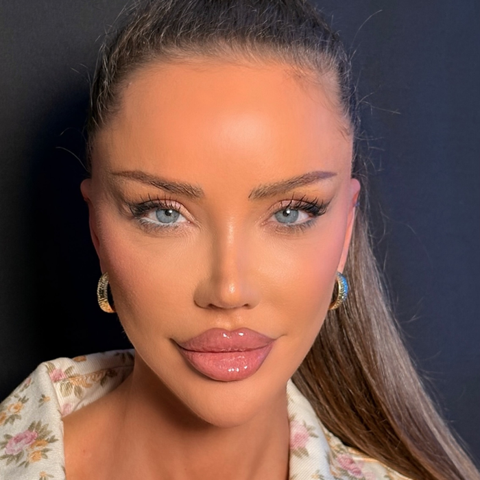 Cum arată Bianca Drăgușanu după ce și-a operat urechile. Cum a decurs intervenția de otoplastie