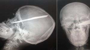 Radiografie socanta! Un tanar a ajuns la spital cu o sabie infipta in cap! A avut un noroc chior si acum e sanatos!