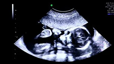 Doctorii au fost ingroziti cand l-au vazut pe acest bebelus: avea 4 maini si 4 picioare! A fost operat la 9 zile dupa nastere