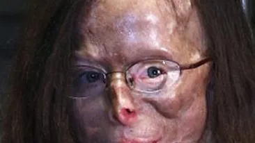 IMAGINI INGROZITOARE! Nasul i se dezintegreaza, nu mai aude si i s-a amputat un deget! Femeia asta a ajuns un cadavru, dupa ce a fost desfigurata cu vitriol de fostul amant!