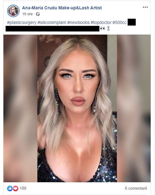 Ana-Maria Crudu și-a schimbat implanturile mamare. Sora Danielei Crudu s-a lăudat cu mililitrii de silicon pe care îi are în fiecare sân