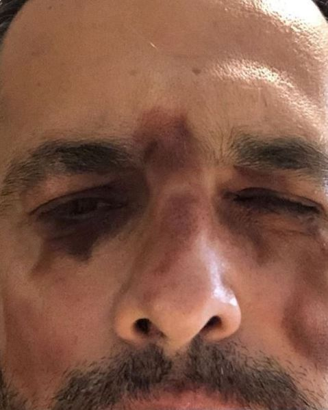 Mădălin Ionescu s-a pozat cu ochii învinețiți: “Am rămas șocat cand m-am văzut în oglindă”