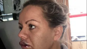 Prin ce dramă a trecut o femeie, după ce și-a mărit buzele: ”Aș fi putut să îmi pierd vederea”