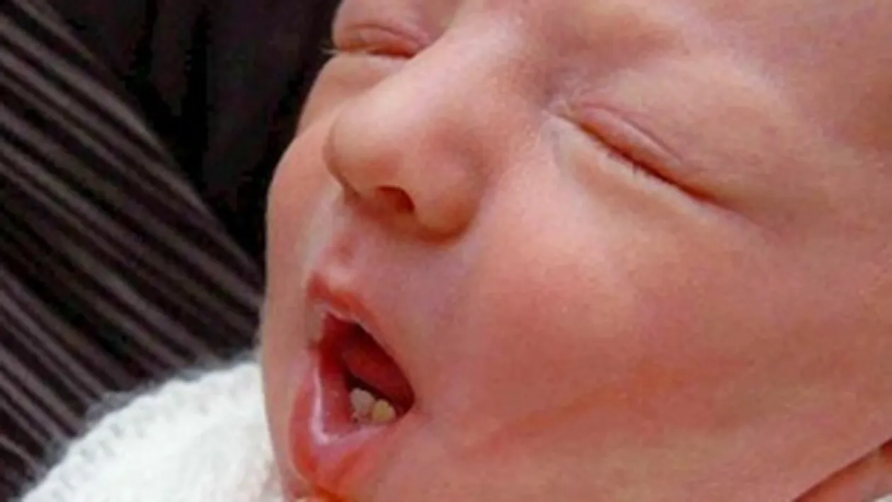Un copil s-a nascut cu doi dinti!