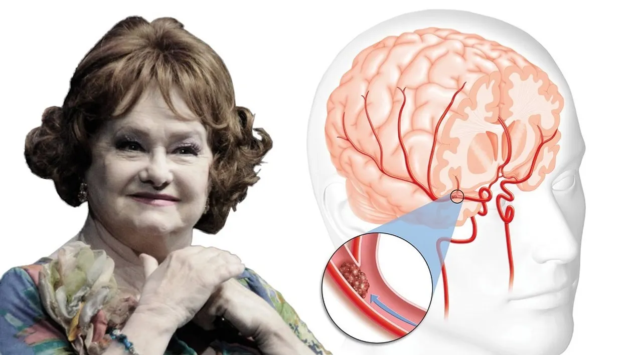 Care sunt simptomele bolii care a ucis-o pe Stela Popescu! Aceştia sunt paşii prin care le poţi recunoaşte. Află cum să te fereşti de un atac cerebral