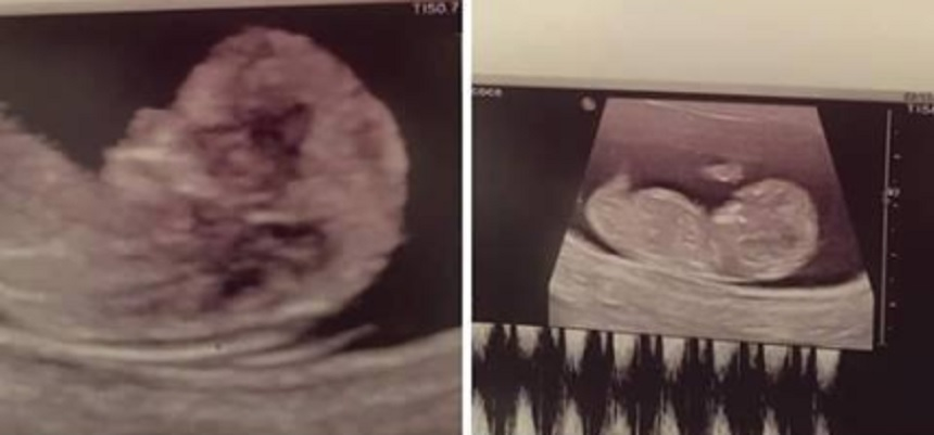 Aceasta e prima ecografie pe care a făcut-o sora Mariei Constantin. Sursa foto: Facebook