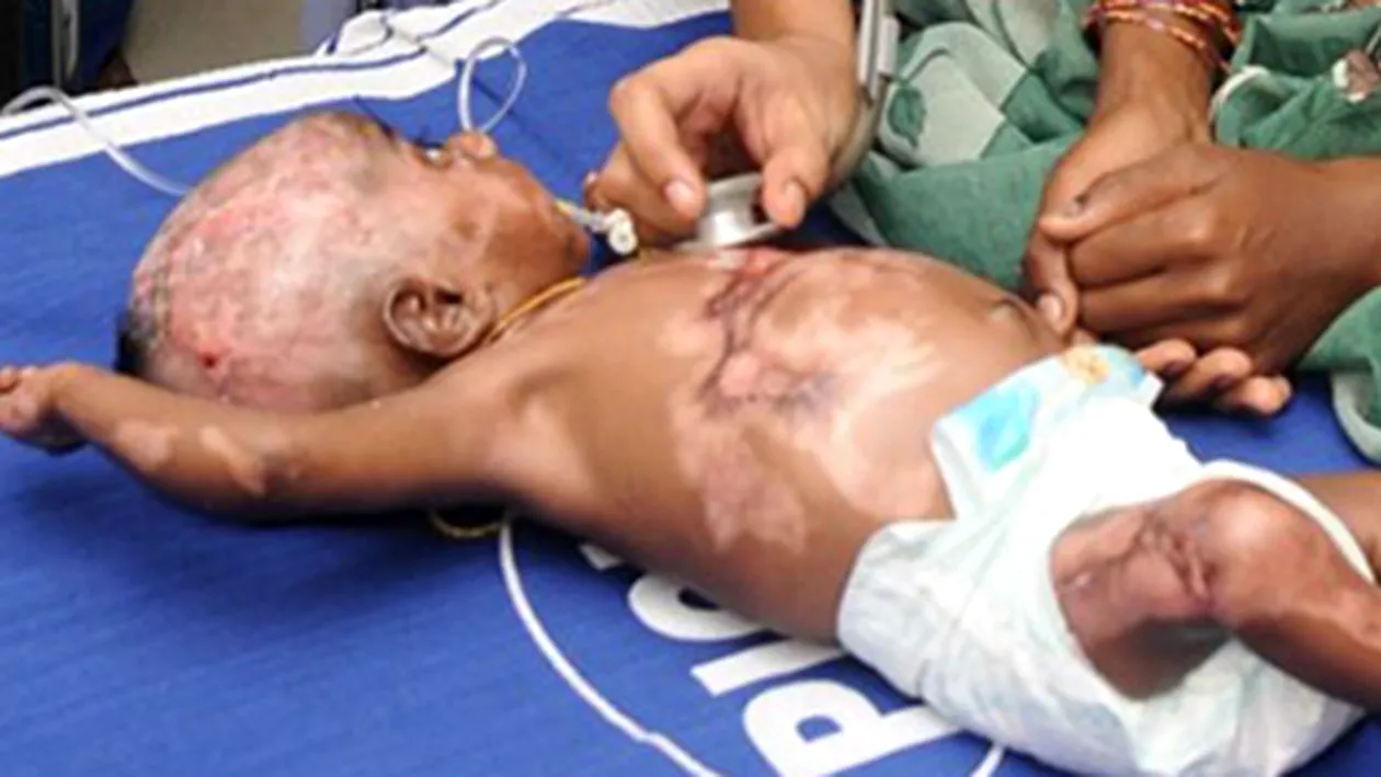 Câtă durere indură la numai 3 luni! Un băietel a ajuns la spital cu arsuri grave, după ce a făcut combustie internă