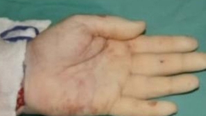 VIDEO Operatie chirurgicala incredibila! I-au transplantat cu succes doua maini