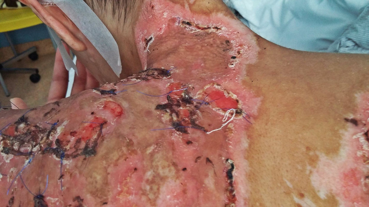 FOTO / Imagini şocante cu unul dintre supravieţuitorii din #Colectiv, dar şi mărturii sfâşietoare despre viaţa mutilată de incendiu: „Tifonul se desface trăgând după el ţesutul necrozat sau fragmentele lizate de grefă, lăsând în urmă doar rană vie, din care şiroieşte sânge roşu, curat”