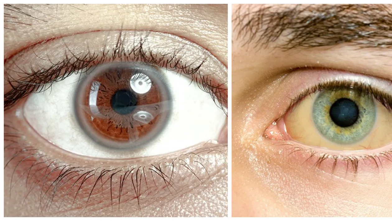 12 lucruri pe care ochii le spun despre sănătatea ta! Nu le ignora, unele sunt grave