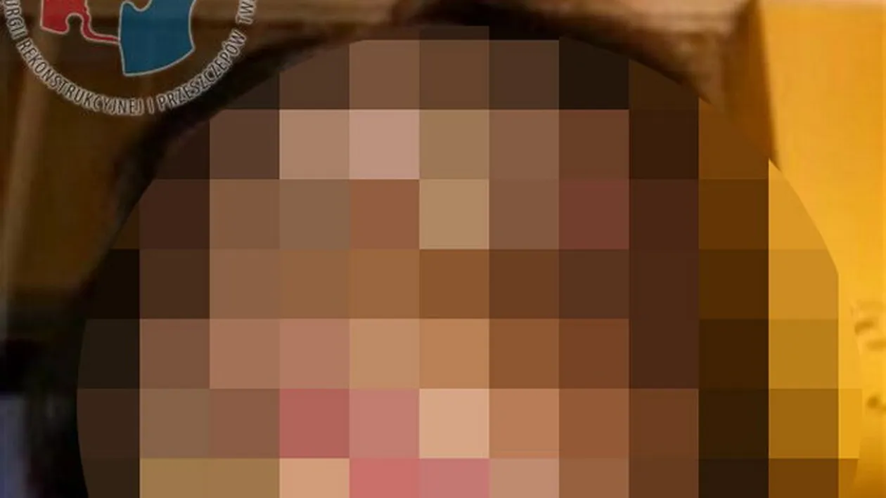 NIMENI nu se putea uita la chipul ei, pentru ca era DESFIGURATA! Cum arata ACUM tanara care semana cu un MONSTRU