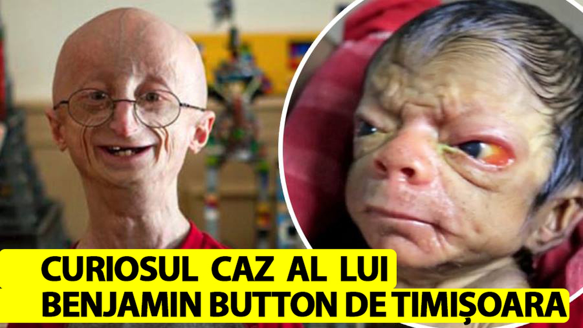 Cum arată acum singurul copil-bătrân din România, care îmbătrânește "invers". Benjamin Button de Timișoara