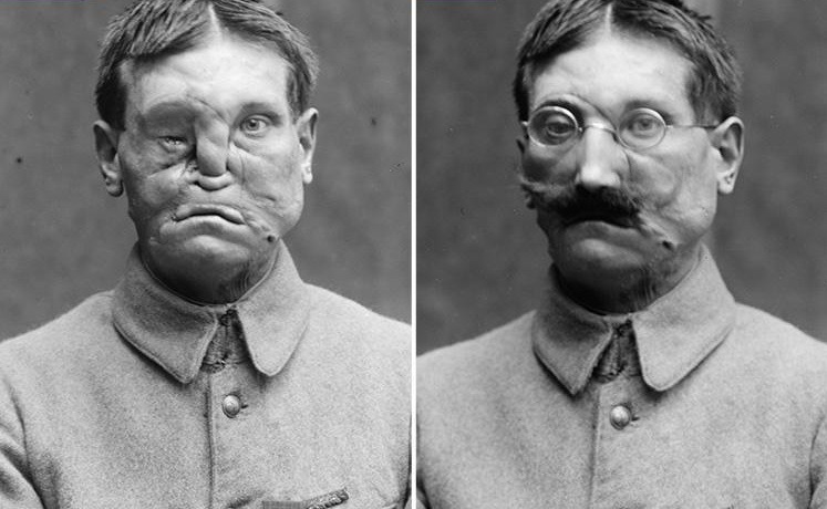 Imagini rare cu soldaţii din Primul Război Mondial! Transformarea incredibilă prin care treceau dacă erau desfiguraţi pe câmpul de luptă