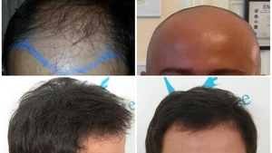 (P) Știai că implant de par Q-FUE manual avansat te ajută să arăți mai tânăr? Iată ce implică