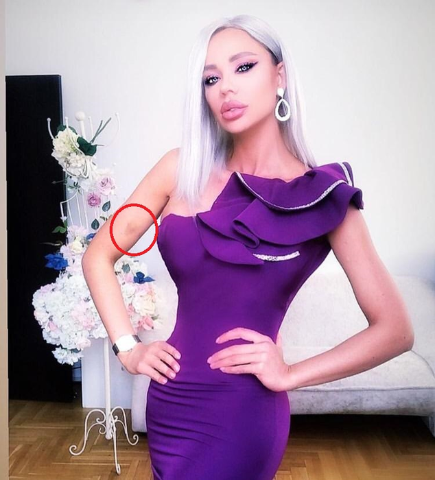 Vânătaia de pe brațul vedetei este destul de vizibilă